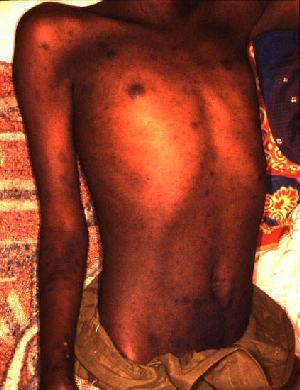 Régi idők járványai, betegségei -  -  - himlő, kolera, malária, pestis, sárgaláz, spanyolnátha, szifilisz, tifusz, 